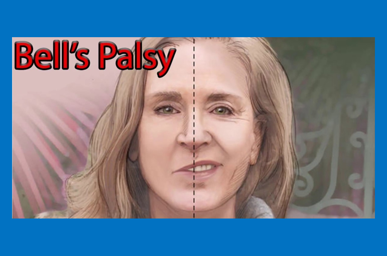 Bell's Palsy Therapy and treatment in Dearborn Michigan with top physical therapist
