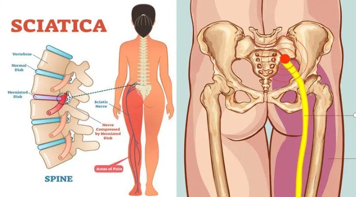 Sciatic nerve therapy and treatment