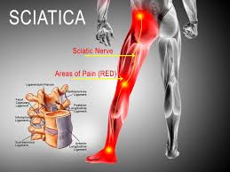 Sciatica Treatment Romulus